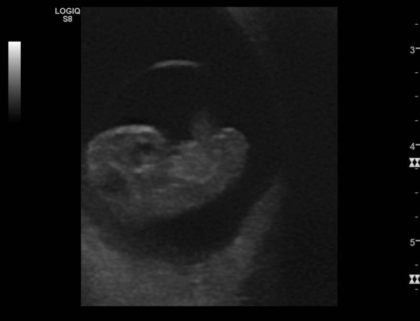 Normal early pregnancy - 8w0d (Radiopaedia 44715-48492 Longitudinal 75).jpg