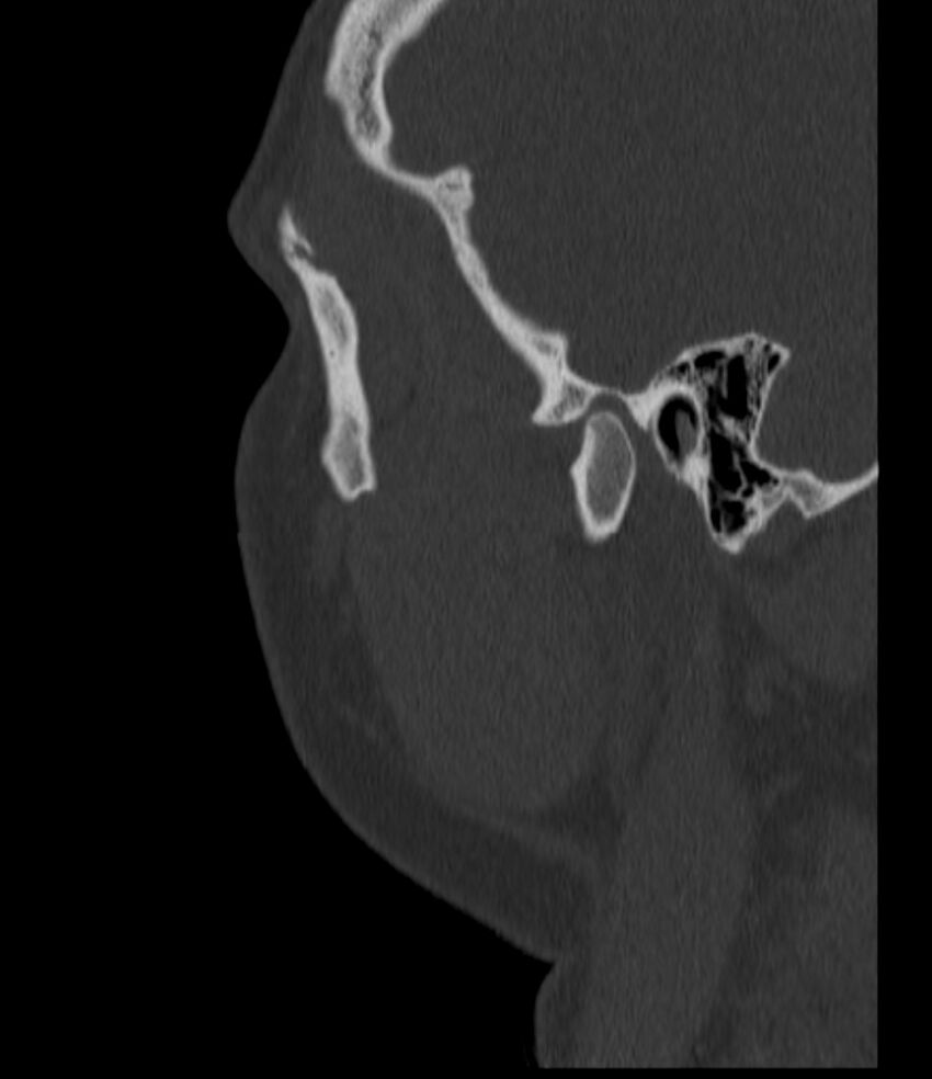 Normal facial bone CT (Radiopaedia 88742-105476 Sagittal bone window 140).jpg