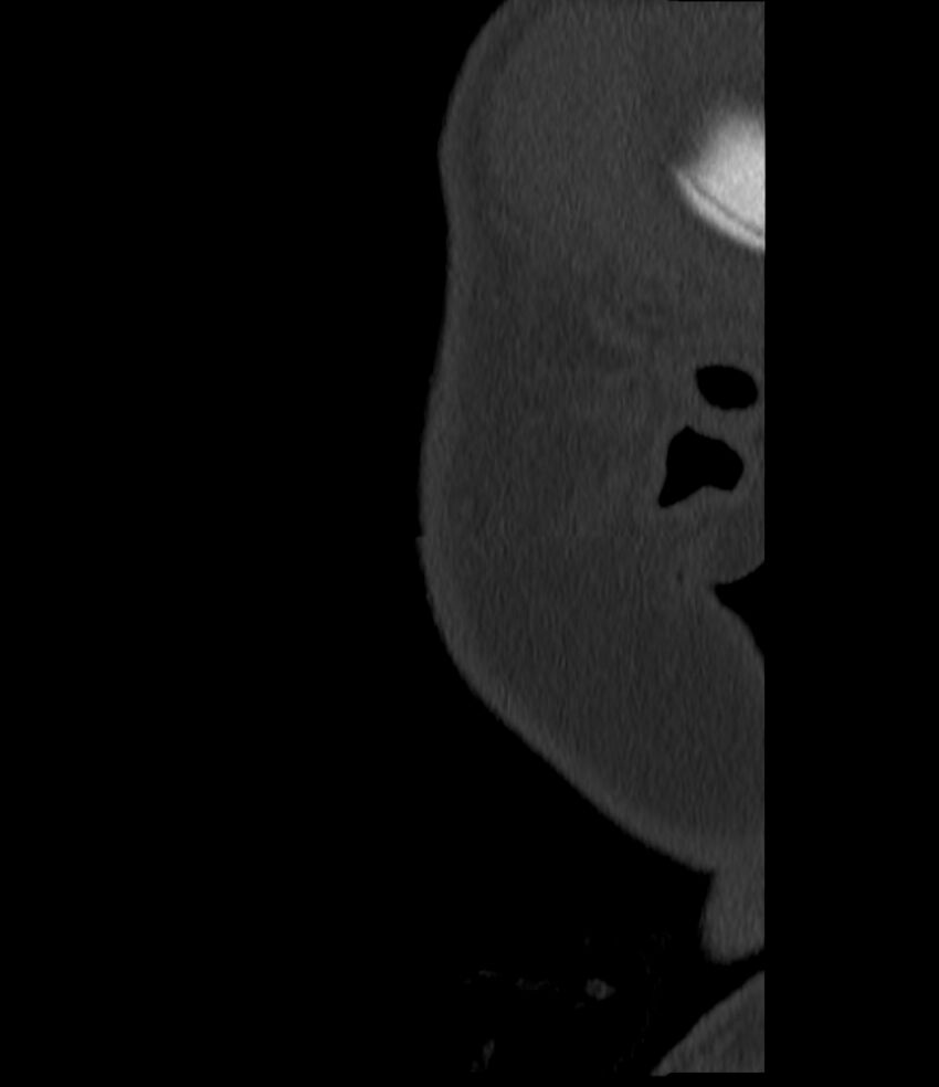 Normal facial bone CT (Radiopaedia 88742-105476 Sagittal bone window 160).jpg