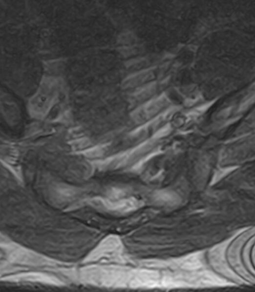 File:Normal lumbar spine MRI - low-field MRI scanner (Radiopaedia 40976-43699 Axial T2 102).jpg
