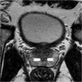 Normal prostate (MRI) (Radiopaedia 29986-30536 G 1).png