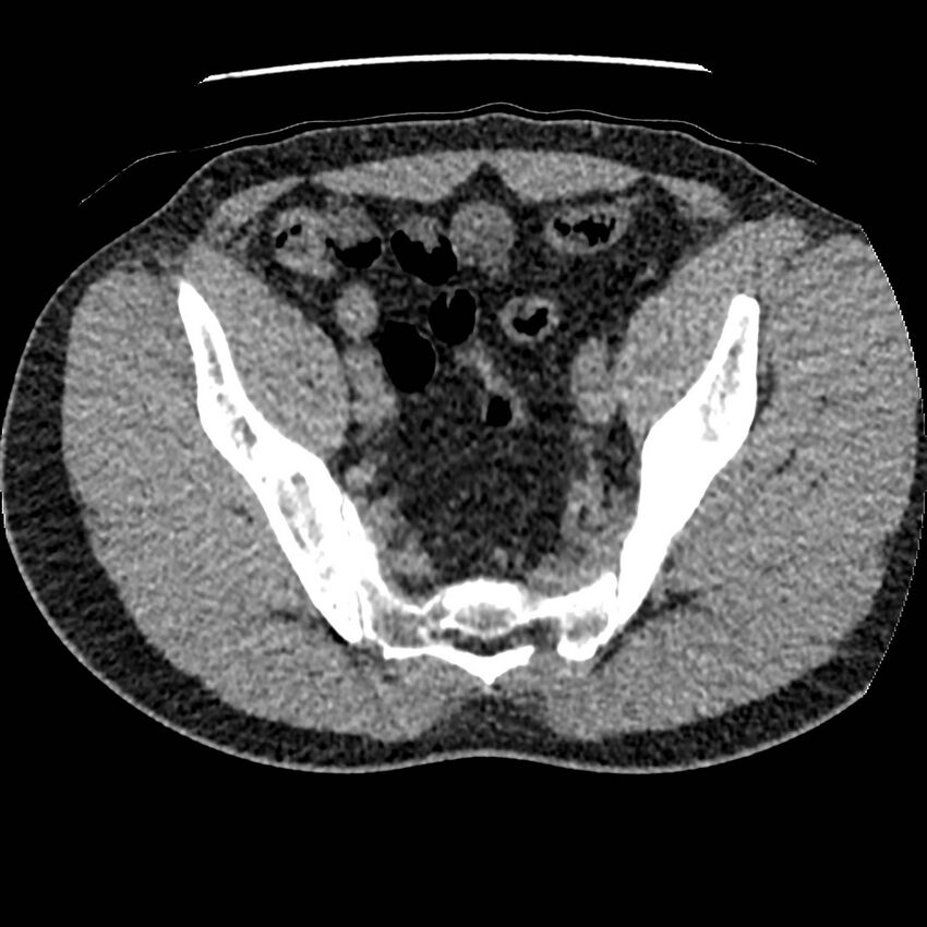 Obstructing ureteric calculus and ureteric anatomy (Radiopaedia 62730-71042 Axial non-contrast 135).jpg