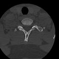 Occipital condyle fracture (Radiopaedia 31755-32691 Axial bone window 70).jpg