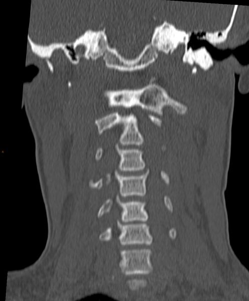 File:Occipital condyle fracture (Radiopaedia 61165-69056 Coronal bone window 11).jpg