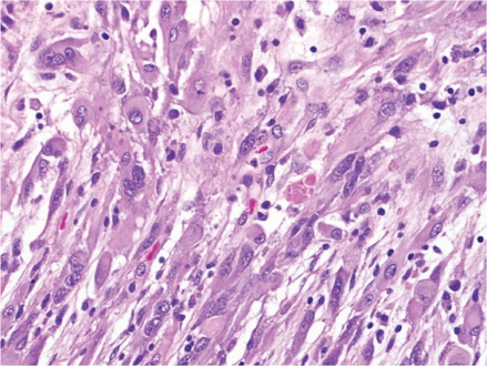 Pleomorphic xanthoastrocytoma (WHO grade II); Pleomorphic xanthoastrocytoma represents a distinctive glioma subtype