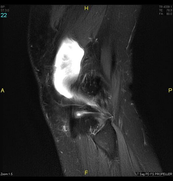 File:ACL mucoid degeration with cystic changes (Radiopaedia 48428-53341 Sagittal PD fat sat 20).jpg