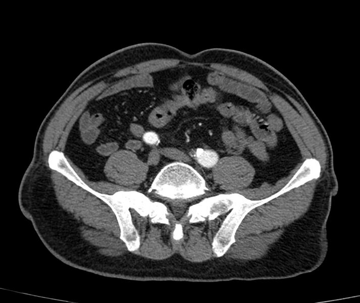 File:Abdominal aortic aneurysm (Radiopaedia 22421-22458 C+ arterial phase 67).jpg