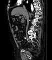 Abdominal aortic aneurysm (Radiopaedia 25855-26001 Sagittal C+ arterial phase 14).jpg