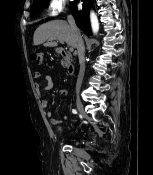 File:Abdominal aortic aneurysm (Radiopaedia 25855-26001 Sagittal C+ arterial phase 14).jpg