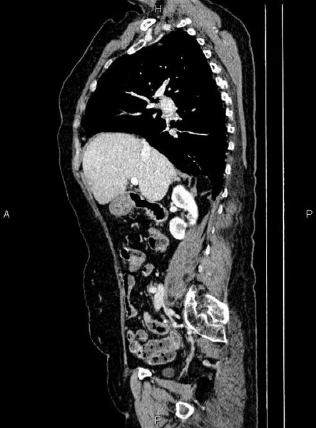File:Abdominal aortic aneurysm (Radiopaedia 85063-100606 Sagittal C+ arterial phase 28).jpg