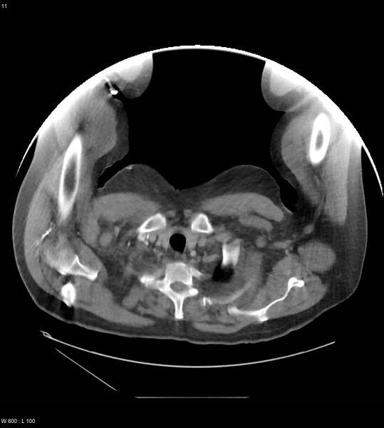 File:Abdominal aortic aneurysm with intramural hematoma then rupture (Radiopaedia 50278-55631 Axial C+ arterial phase 2).jpg