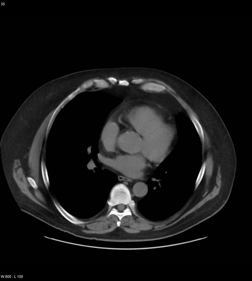Abdominal aortic aneurysm with intramural hematoma then rupture (Radiopaedia 50278-55631 Axial non-contrast 31).jpg