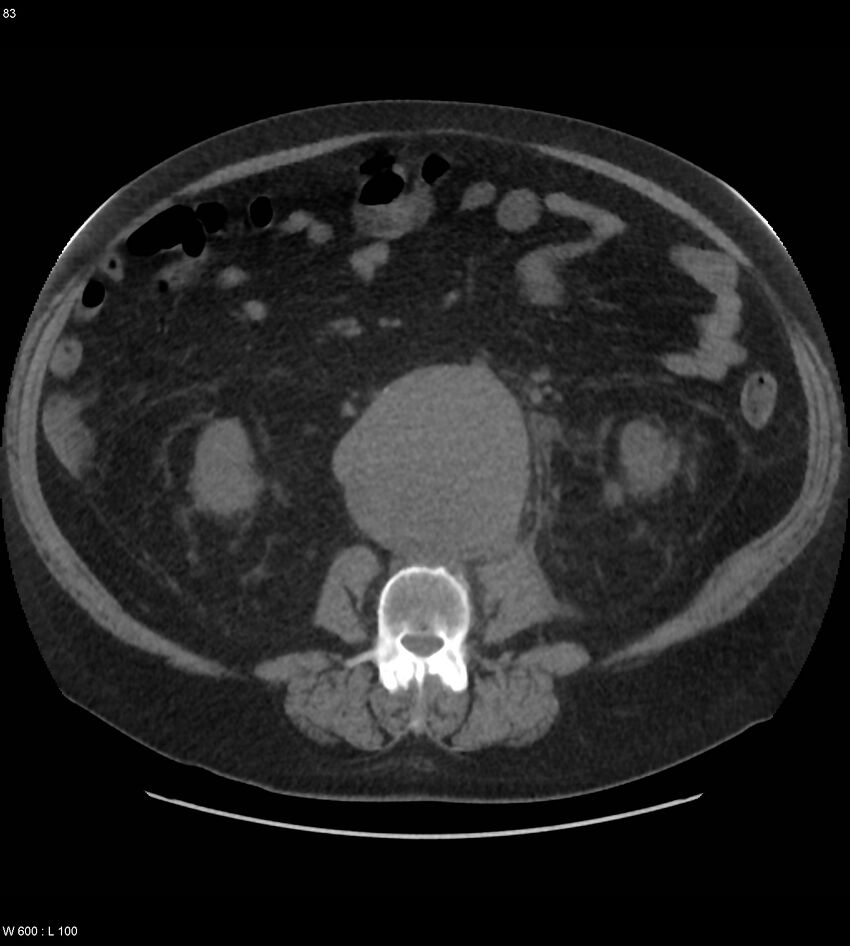 Abdominal aortic aneurysm with intramural hematoma then rupture (Radiopaedia 50278-55631 Axial non-contrast 79).jpg