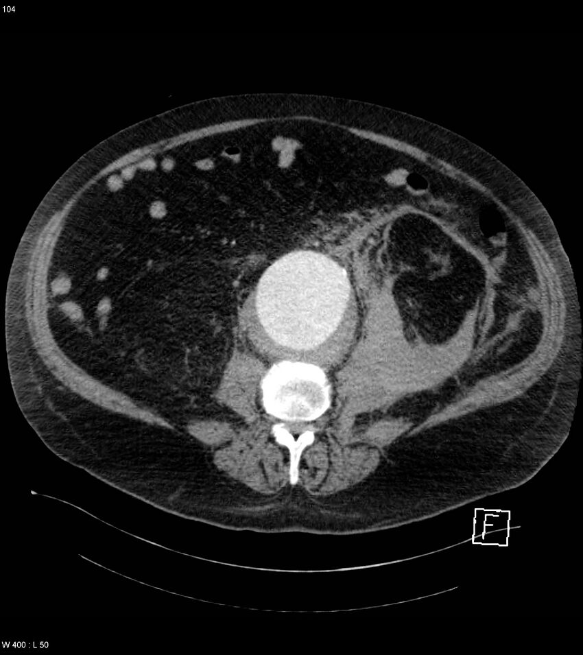 Abdominal aortic aneurysm with intramural hematoma then rupture (Radiopaedia 50278-55632 Axial C+ arterial phase 103).jpg