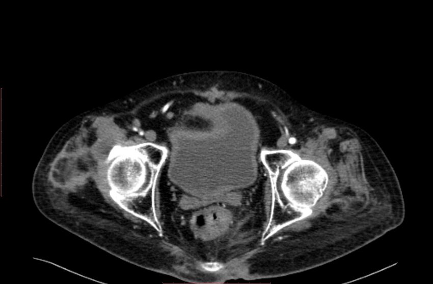 Abdominal aortic interposition tube graft and aneurysm thrombosis (Radiopaedia 71438-81857 Axial C+ arterial phase 224).jpg
