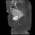 Abdominal wall endometriosis (Radiopaedia 83702-98847 Sagittal T1 C+ fat sat 12).jpg
