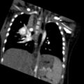 Aberrant left pulmonary artery (pulmonary sling) (Radiopaedia 42323-45435 Coronal C+ CTPA 11).jpg