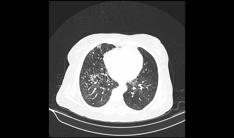 File:Acquired tracheo-esophageal fistula (Radiopaedia 51356-57103 Axial lung window 28).jpg