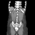 Actinomycosis related to longstanding IUD (Radiopaedia 77303-89380 Coronal C+ portal venous phase 52).jpg