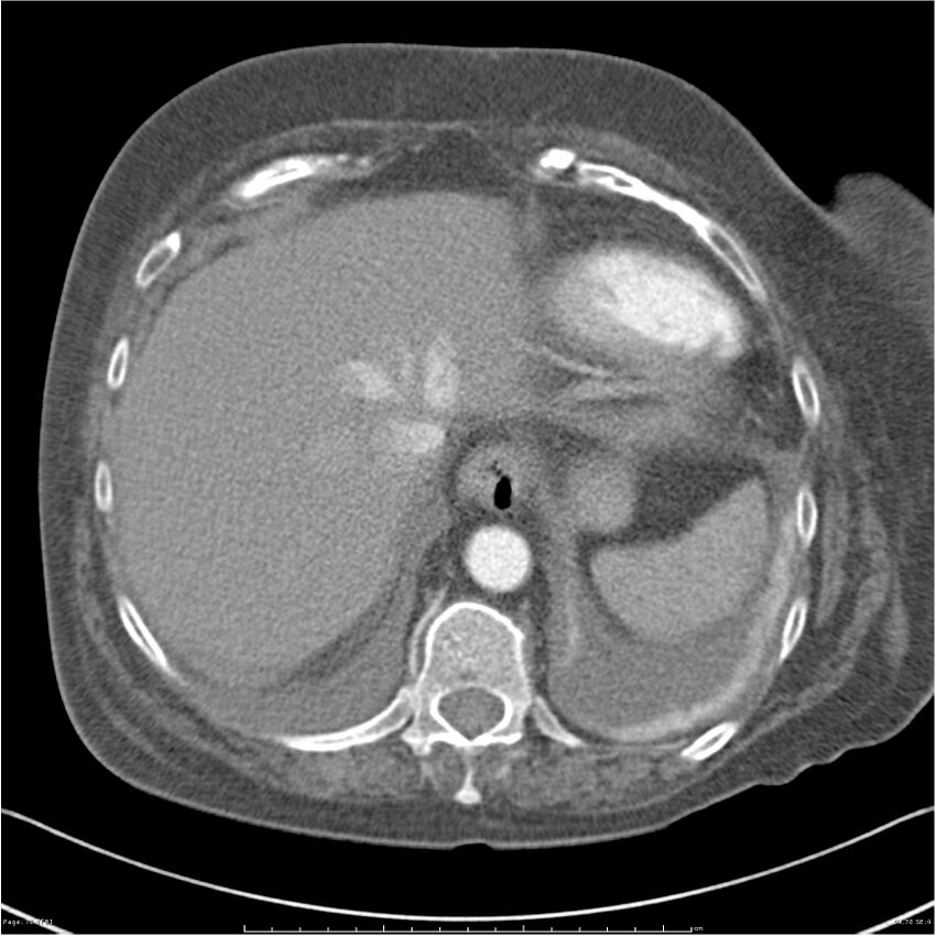 Acute-on-chronic pulmonary emboli (Radiopaedia 27925-28169 C+ CTPA 70).jpg