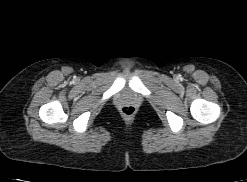 Acute Budd-Chiari syndrome (Radiopaedia 60858-68638 Axial C+ portal venous phase 311).jpg