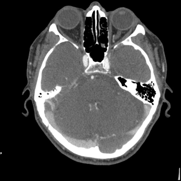 File:Acute P1 occlusion with PCA ischemia penumbra (CT perfusion) (Radiopaedia 72084-82587 Axial C+ arterial thins 72).jpg