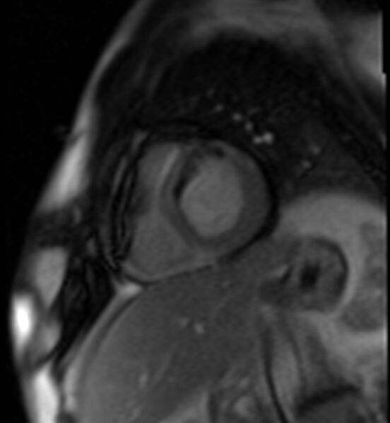 File:Acute anteroseptal myocardial infarction (Radiopaedia 68409-77945 Short axis (basal) Perfusion 29).jpg
