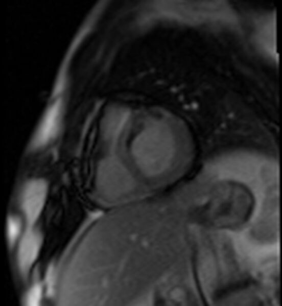 File:Acute anteroseptal myocardial infarction (Radiopaedia 68409-77945 Short axis (basal) Perfusion 32).jpg