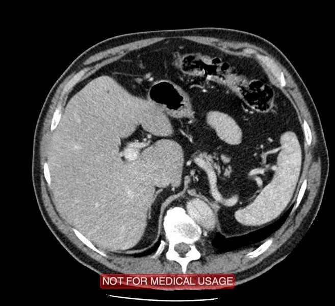 File:Acute aortic dissection - Stanford type A (Radiopaedia 40661-43285 Axial C+ portal venous phase 69).jpg