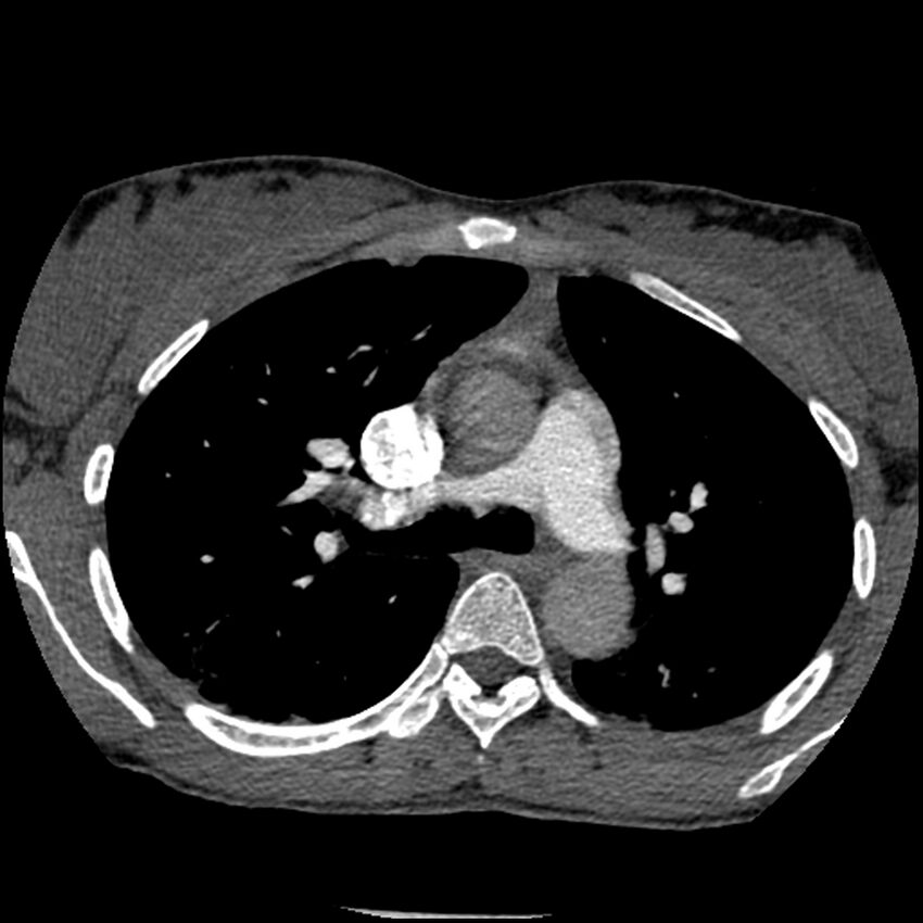 Acute chest syndrome - sickle cell disease (Radiopaedia 42375-45499 Axial C+ CTPA 69).jpg