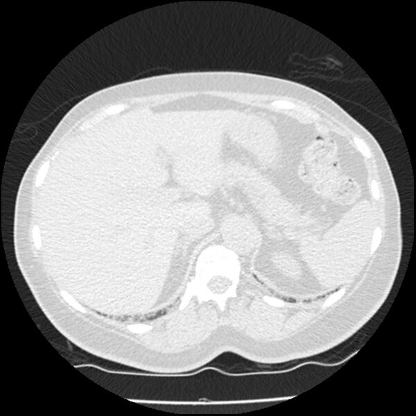 File:Acute interstitial pneumonitis (Radiopaedia 45404-49444 Axial lung window 96).jpg