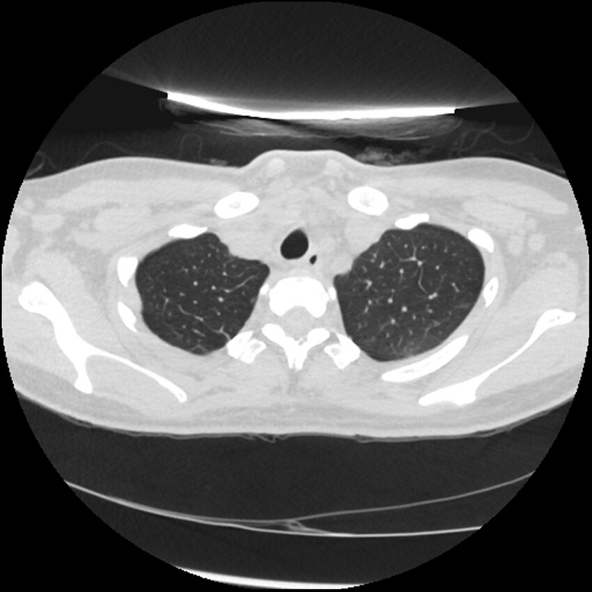 Acute lupus nephritis (Radiopaedia 45832-50107 Axial lung window 12).jpg