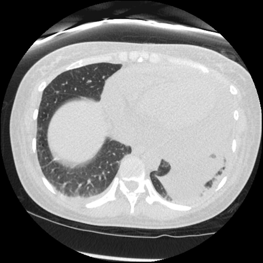 Acute lupus nephritis (Radiopaedia 45832-50107 Axial lung window 75).jpg