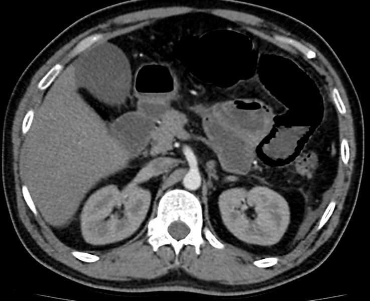 File:Acute mesenteric ischemia - superior mesenteric artery thrombosis (Radiopaedia 73947-84776 Axial C+ arterial phase 23).jpg