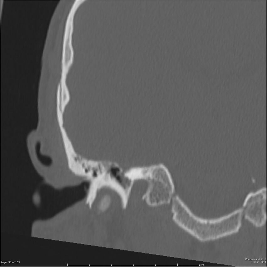 Acute otomastoiditis (Radiopaedia 28276-28512 Coronal PTB bone window reformat 21).jpg