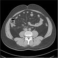 Acute pancreatitis - mild (Radiopaedia 27796-28033 Axial non-contrast 35).jpg