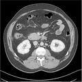 Acute pancreatitis - mild (Radiopaedia 27796-28033 C+ portal venous phase 21).jpg