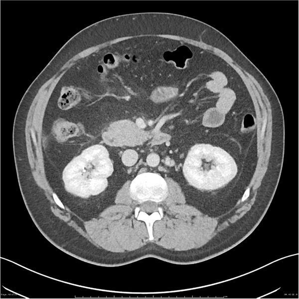 File:Acute pancreatitis - mild (Radiopaedia 27796-28033 C+ portal venous phase 21).jpg