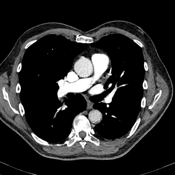 File:Acute pulmonary embolism (Radiopaedia 81677-95570 Axial C+ CTPA 44).jpg
