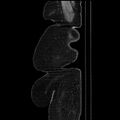 Acute pyelonephritis (Radiopaedia 25657-25837 Sagittal renal parenchymal phase 9).jpg