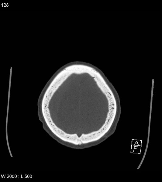 File:Acute subdural hematoma with myelofibrosis (Radiopaedia 52582-58494 Axial bone window 64).jpg