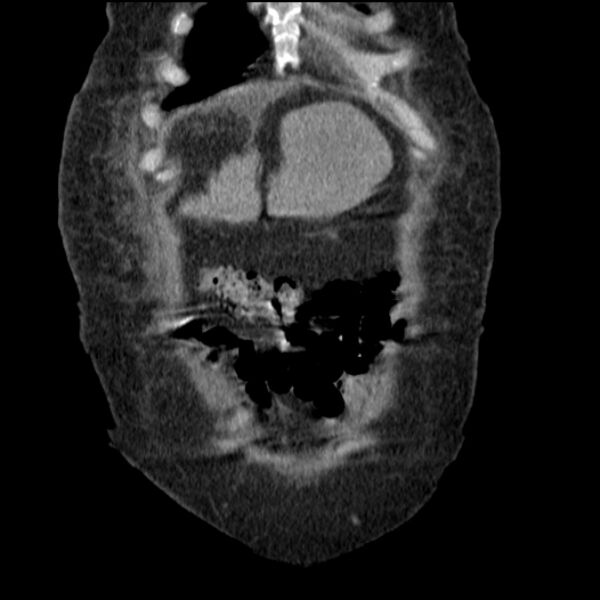 File:Acute tubular necrosis (Radiopaedia 28077-28334 D 17).jpg