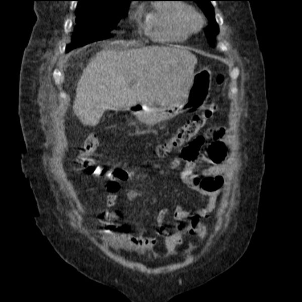 File:Acute tubular necrosis (Radiopaedia 28077-28334 G 25).jpg