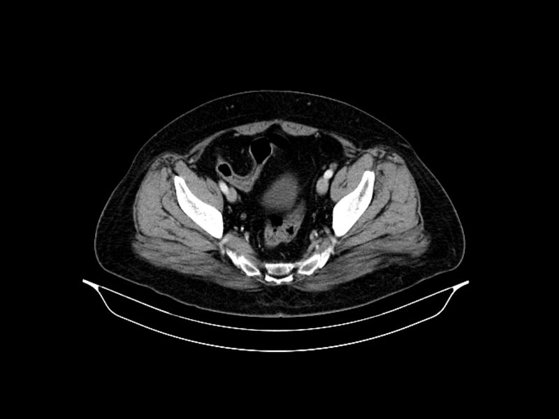 File:Adenocarcinoma of pancreas with hepatic metastasis (Radiopaedia 64332-73122 Axial C+ portal venous phase 87).jpg