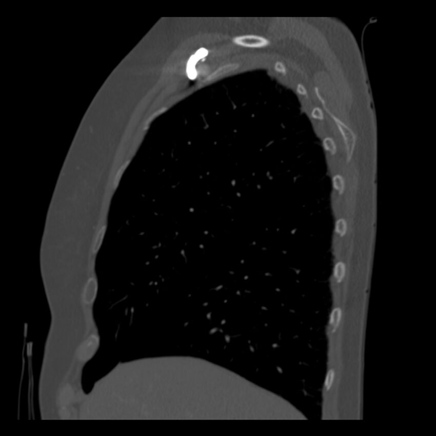 Adenocarcinoma of the lung (Radiopaedia 41015-43755 Sagittal bone window 20).jpg