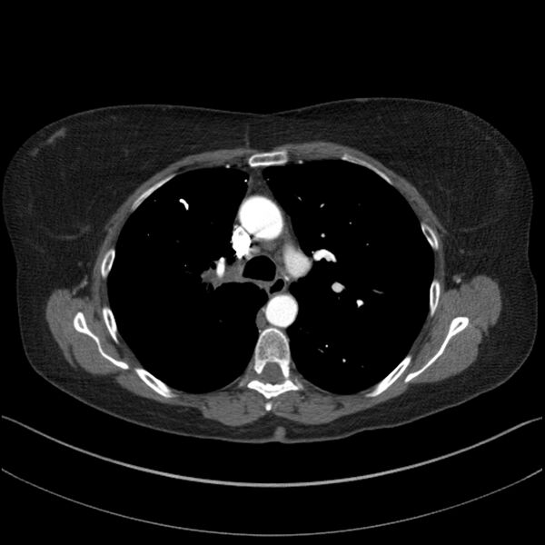 File:Adenocarcinoma of the lung (Radiopaedia 44205-47803 Axial C+ portal venous phase 32).jpg