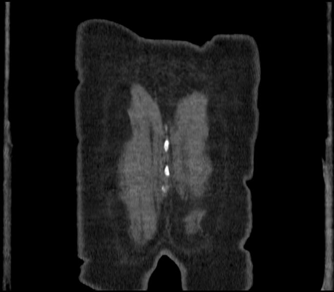 File:Adenocarcinoma of the lung (Radiopaedia 44205-47803 Coronal C+ portal venous phase 100).jpg