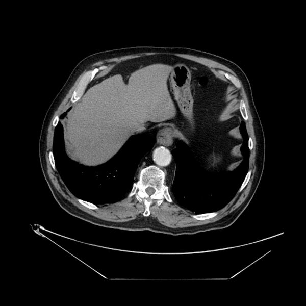 File:Adenocarcinoma of the lung (Radiopaedia 44876-48759 Axial C+ portal venous phase 71).jpg