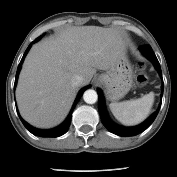 File:Adenocarcioma of rectum- T1 lesion (Radiopaedia 36921-38564 A 3).jpg