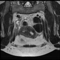 Adenoma malignum of the cervix (Radiopaedia 24460-24765 Coronal T2 5).jpg